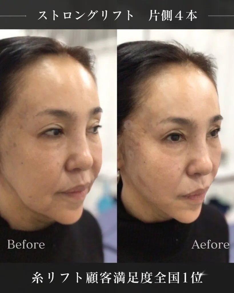 ストロングリフト2
